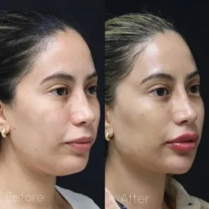 lip fillers