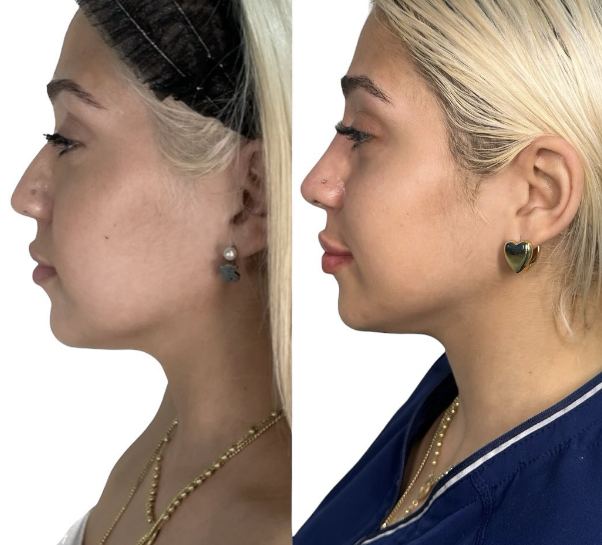 Read more about the article Non-Surgical Nose Job at White Coat Beauty in Miami, FL