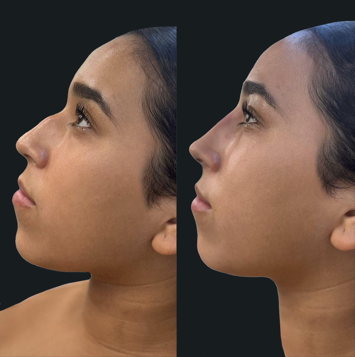 Read more about the article Non-Surgical Nose Job at White Coat Beauty in Miami, FL