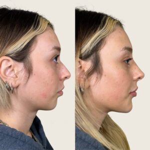 mini-harmonization-nose-chin-lips