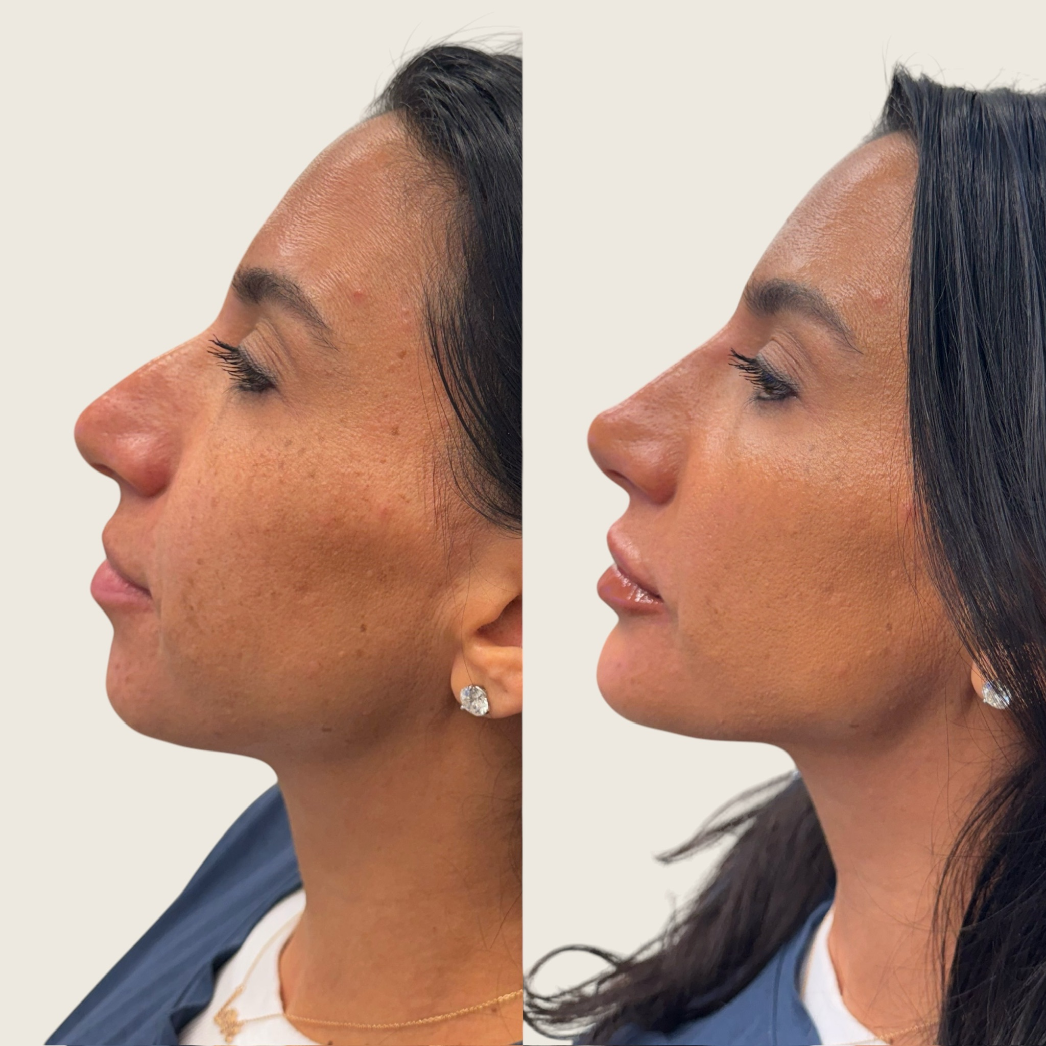 mini-harmonization-nose