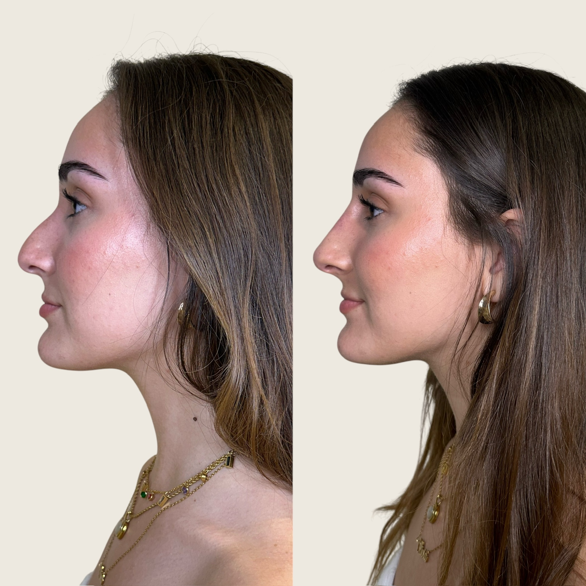nose-1