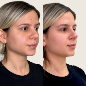 nose-2