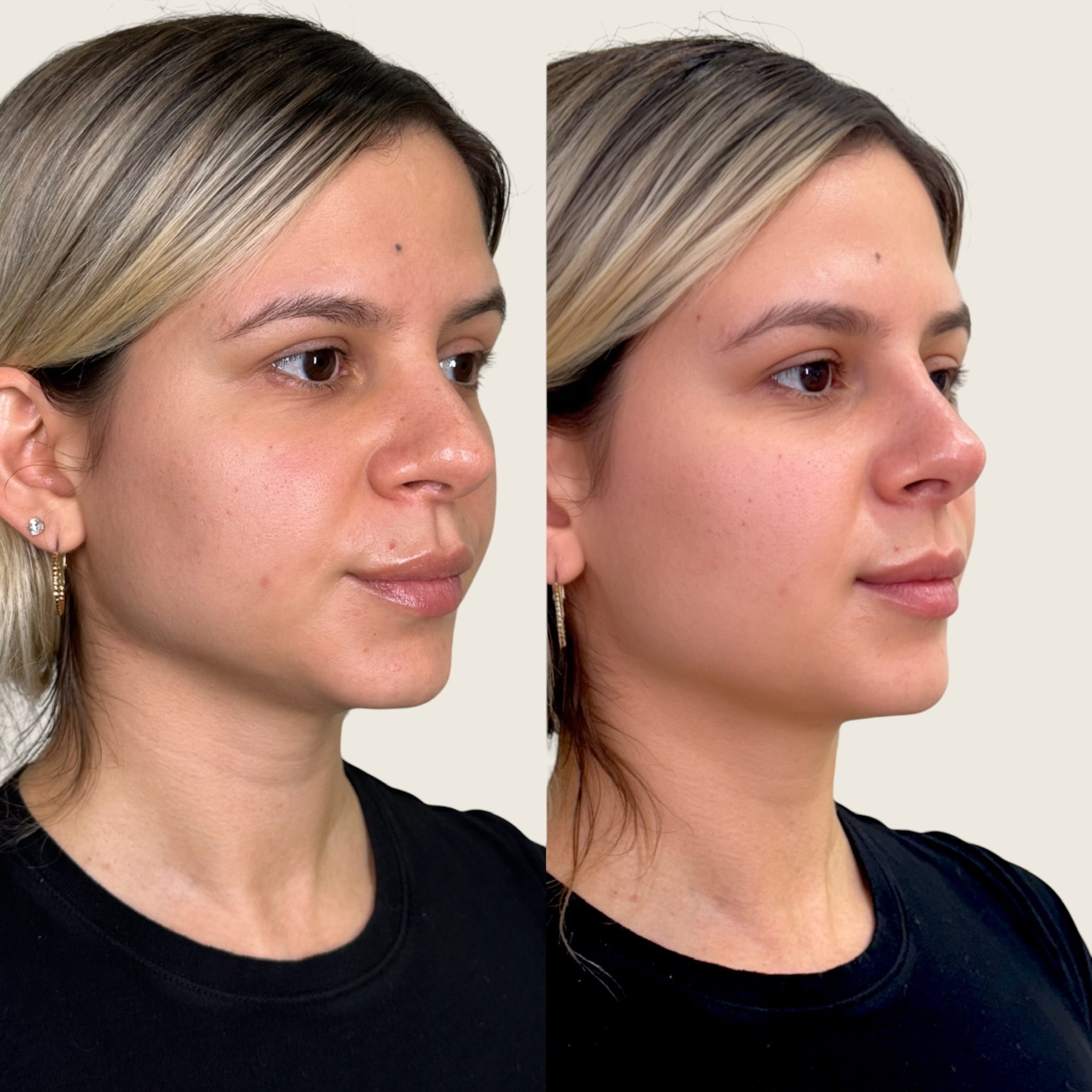 nose-2