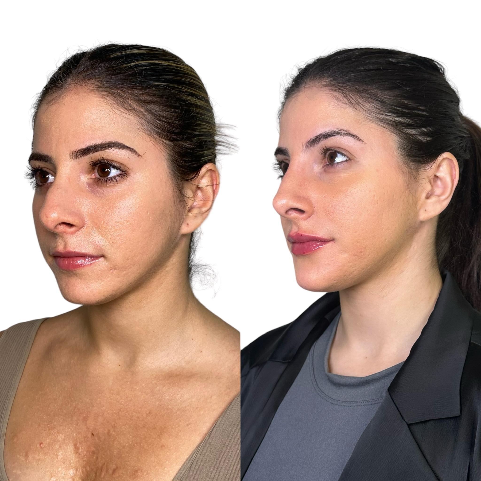 Non surgical nose